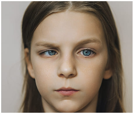 Children with Binocular vision dysfunction (BVD)
